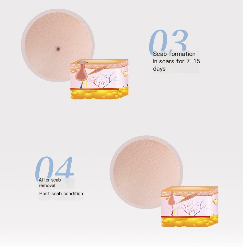 Beauty Mole Pen Image 7