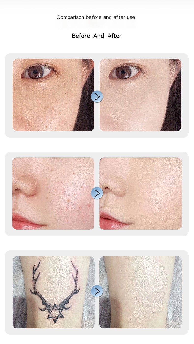 Beauty Mole Pen Image 8