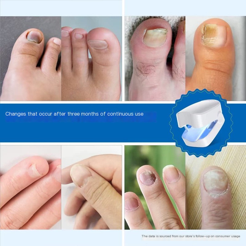 Portable Fungal Nail Treatment Lamp