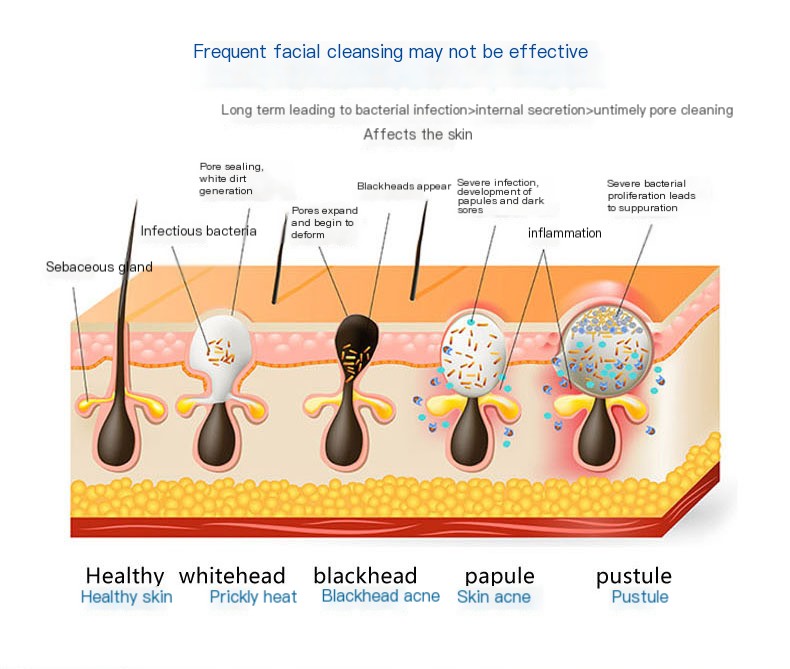 Blackhead Remover in Use