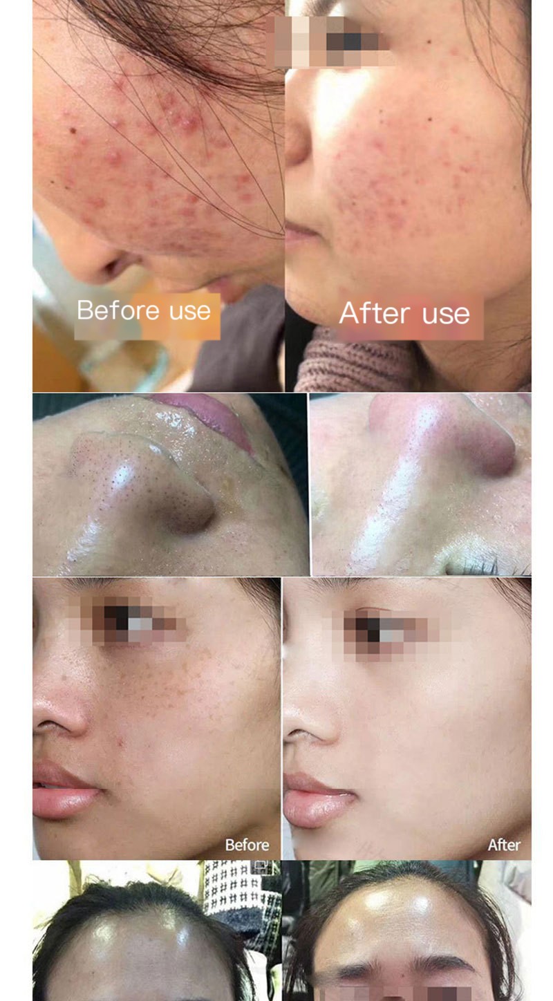 Seaweed silicone needle plant sponge micro needle skin rejuvenation bone needle acne pit acne marks repair skin dark yellow beauty salon special